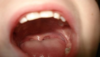 mouthsyndrome artikel